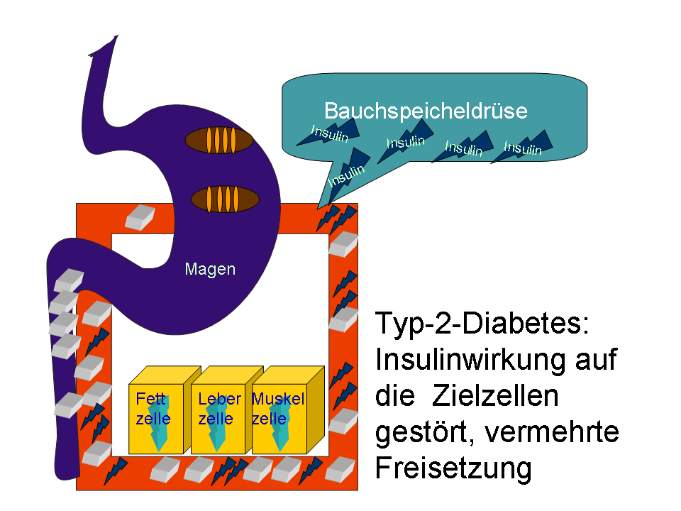 Latenter Diabetes Mellitus: Die stille Gefahr